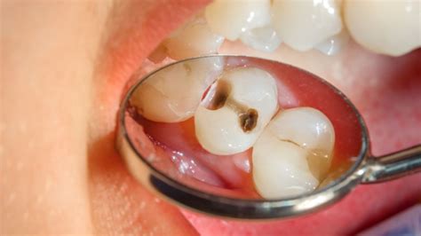Image result for Stumpy Black Teeth