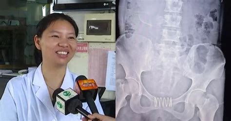 Woman Put Spring In Her Vagina Confusing It As Contraceptive, And ...