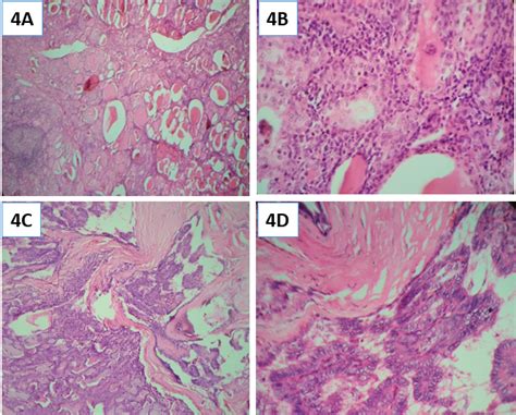 Papillary thyroid carcinoma and its variants in tertiary care hospital ...