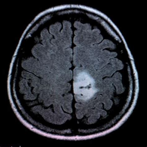 Brain Tumor MRI Image Classification | Kaggle