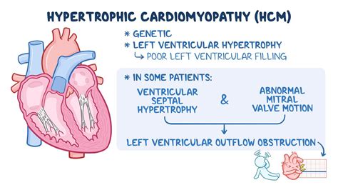 Video: Hypertrophic cardiomyopathy: Clinical sciences | Osmosis