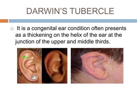 Congenital ear deformities | PPTX