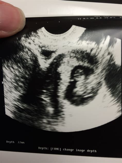 A High-Risk Pregnancy Success Story: I have a Bicornuate Uterus ...