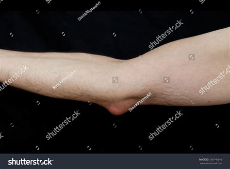 Olecranon Bursitis Known Student Elbow Medical库存照片159146546 | Shutterstock