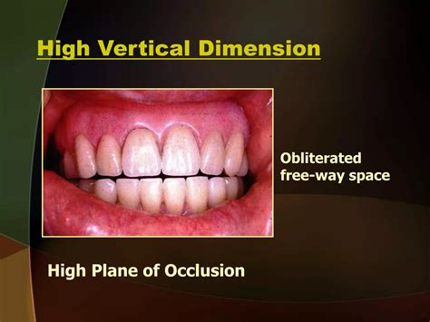 Complete Denture 4- Maxillo-mandibular Relation Records d- Vertical ...