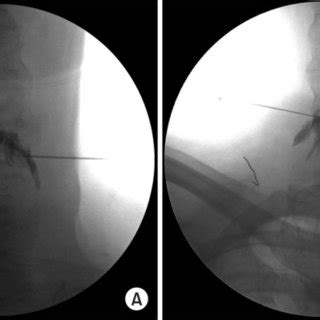 Image result for Selective Nerve Root Block C6