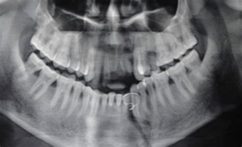 Oral Pre Cancer And Cancer Management | Oral Cancer Treatment in Mumbai