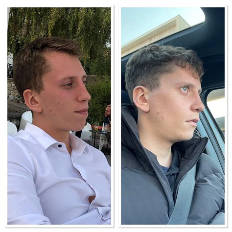 4 weeks post op. Double jaw surgery : r/jawsurgery