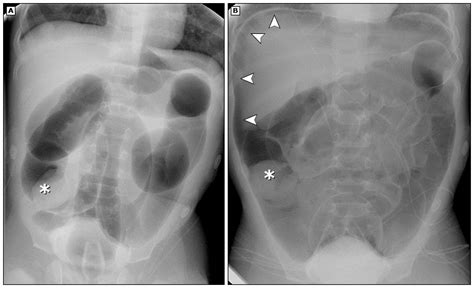 Image result for Intussusception Symptoms