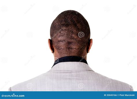 Male Head With Thinning Hair Or Alopecia, Balding Royalty-Free Stock ...