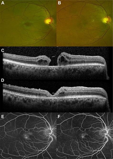 Surgical Management of Full-Thickness Macular Holes in Macular Telangiectasia Type 2 - Ophthalmology