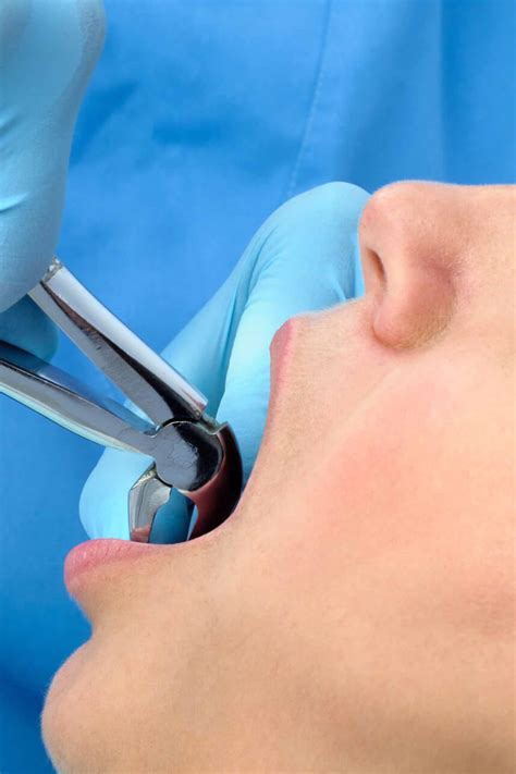 Image result for Tooth Extraction HD Images