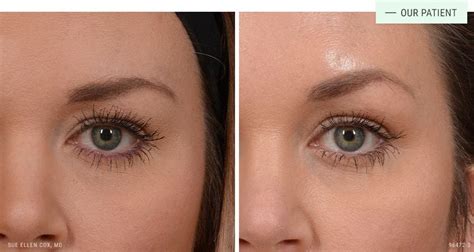 Image result for Thread Brow Lift Procedure