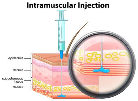 Site Intramuscular Injection