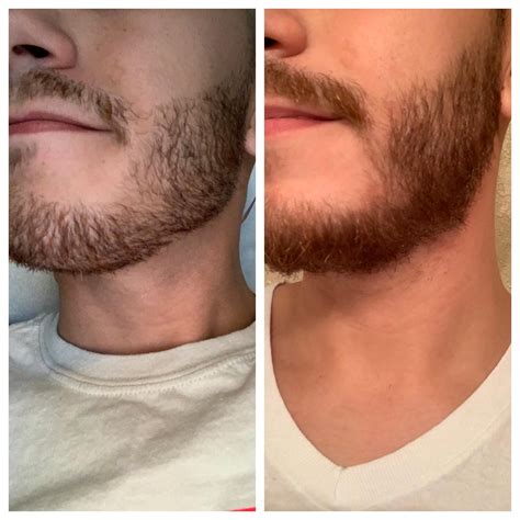 Patchy beard. Will the patch go away ? 18 days vs 40 days | Patchy ...