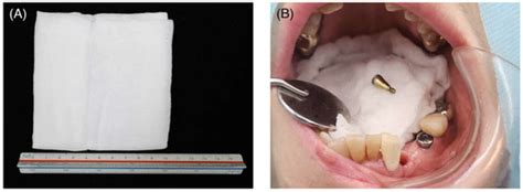 Preventing Foreign Body Aspiration and Ingestion with a Damp Gauze in ...