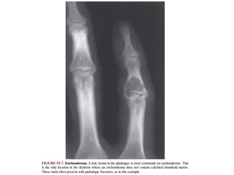 Lytic lesions of bone | PPTX
