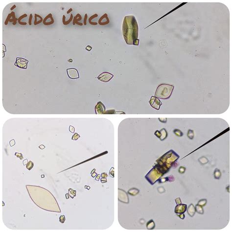 Uroanalisis en 2025 | Cristales, Ácido úrico, Urinarios