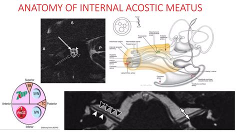 Mri procedure of INTERNAL ACOSTIC MEATUS | PPTX