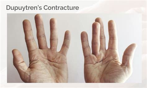 Dupuytren's Contracture | CheckRare.com