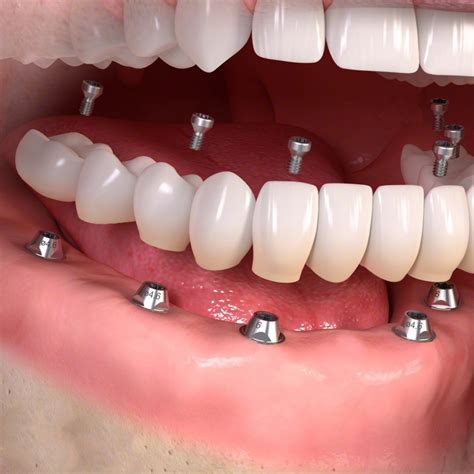 Fixedimplant | 3D Dental & Implant Clinic