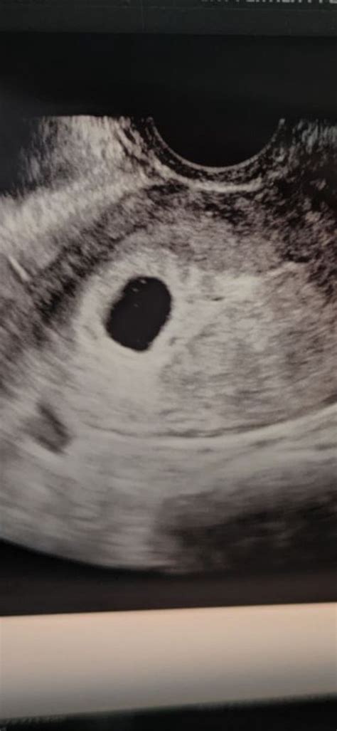 Empty gestational sac? Help! | BabyCenter