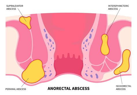 Buttock Abscess: What is it and how to get rid of it? - Colorectal Care ...