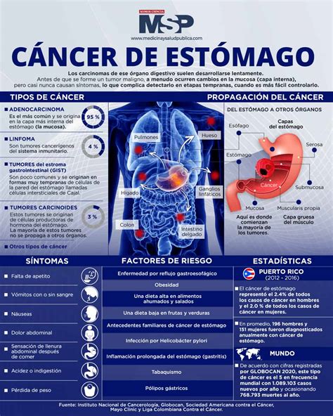 Cáncer de estómago - Infografía