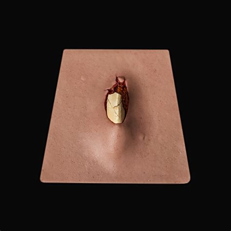 Image result for Open Fracture Surgery