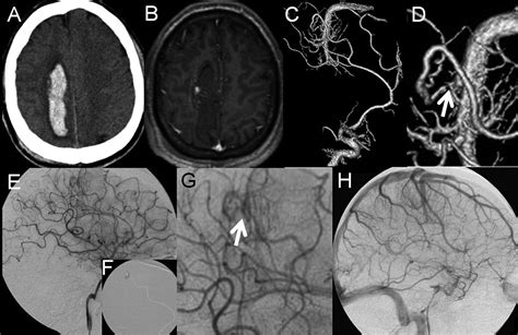 Pathomechanisms of Symptomatic Developmental Venous Anomalies | Stroke