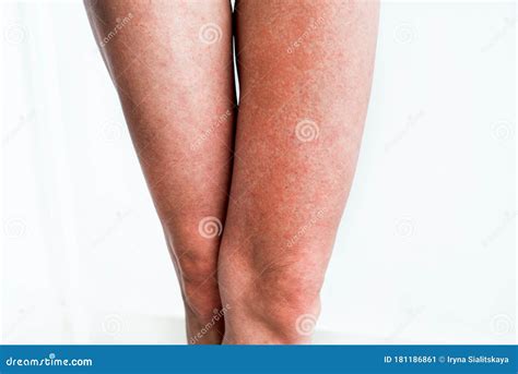 Severe Sunburn, Summer Tan, Poor Sun Protection. Sun Allergies, Obstruction, Itching Pain and ...