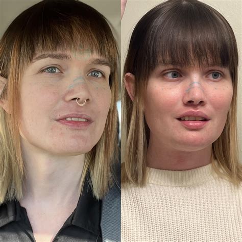 Bottom Surgery (Vaginoplasty) with Dr. Del Corral (Baltimore, Maryland) on March 30, 2022. I’m ...