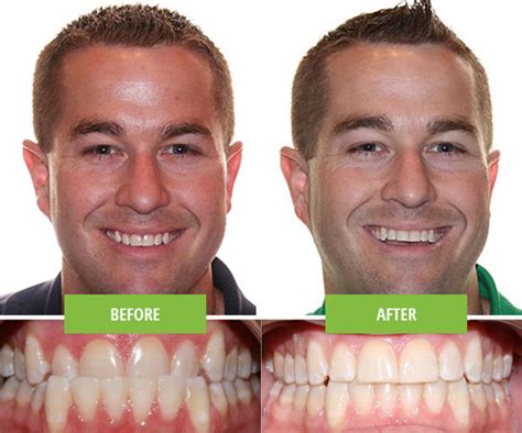 Image result for Invisalign Scanning Step by Step