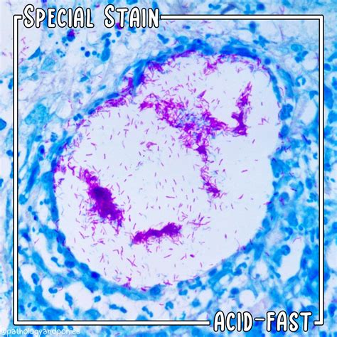 Special Stain: Acid-Fast - Pathology and Ponies