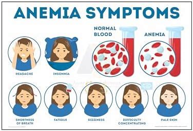 Anne Print Solutions® Anemia symptoms poster (Without Frame) For ...