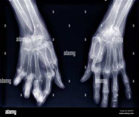 X Ray Hands Rheumatoid Arthritis Stock Photo 120872 Rheumatoid