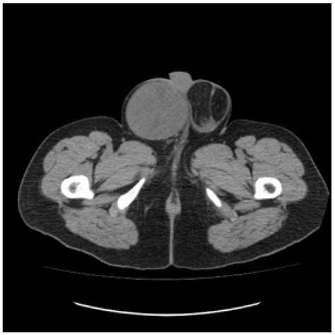 Delivering Chemotherapy to a Metastatic Poor Risk Testicular Cancer ...