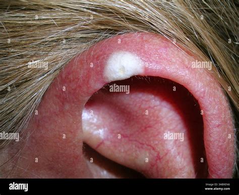 Patient being treated with cryotherapy for chondrodermatitis nodularis ...