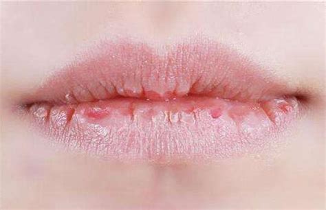 【图】嘴唇上长泡是什么原因 要怎么解决_嘴唇上长泡_伊秀美容网|yxlady.com