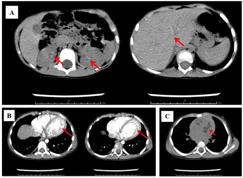 A Unique Case of a Child with Two Rare Hereditary Diseases: Familial ...