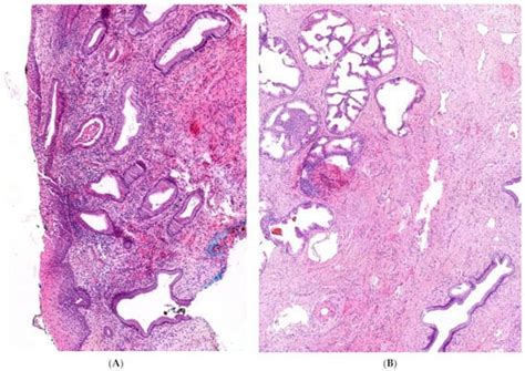 Ectopic Prostate Tissue in the Uterine Cervix of a Female with Non ...