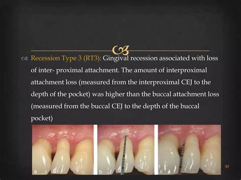 Gingival recession classifications | PPTX