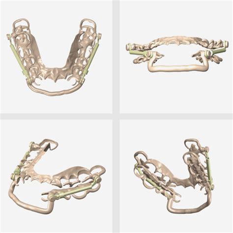 Somnowell Chrome Mandibular Advancement Device | Intus Healthcare
