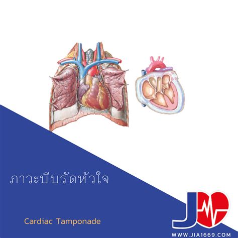 Cardiac Tamponade - jia1669
