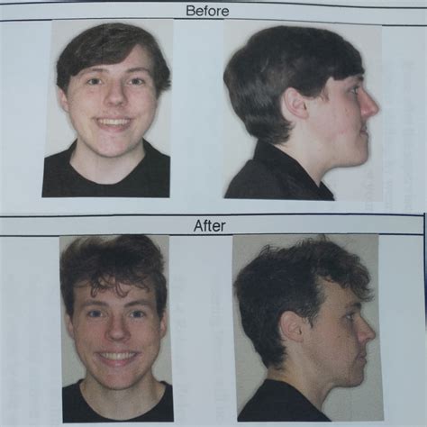 (M20) Before and after of double jaw + SARPE surgery! I like to think I turned out alright : r ...