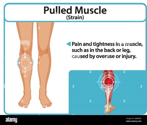 Illustration of muscle strain in the leg Stock Vector Image & Art - Alamy