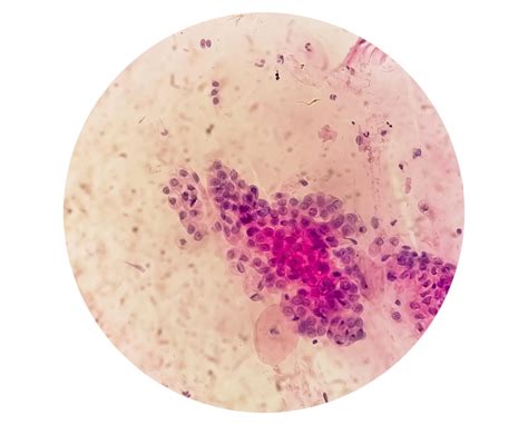 Premium Photo | Trichomonas vaginalis in pap smear with few acute inflammatory cells ...
