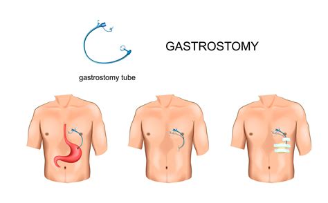 G Tube Placement Cpt Code