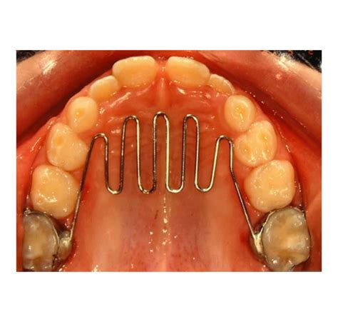 Habit Breaking Appliance In Ghaziabad | India