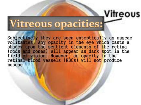PPT - Vitreous Anatomy & Diseases: Understanding Symptoms, Causes, and Treatment Options ...